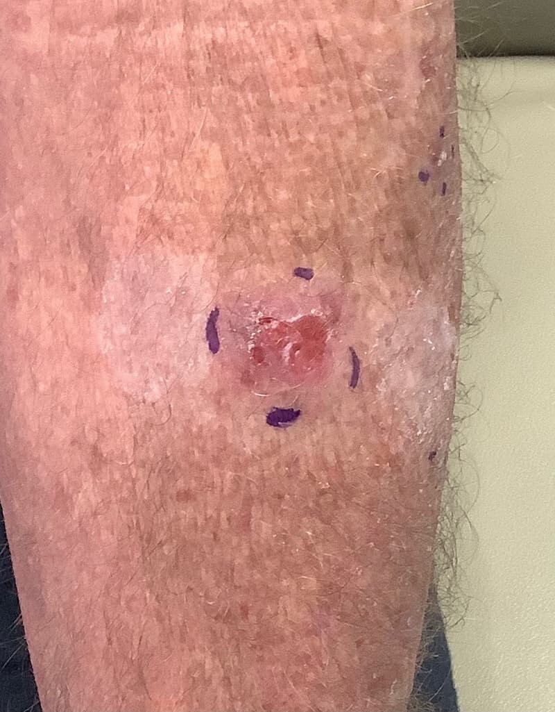 basal cell carcinoma on back