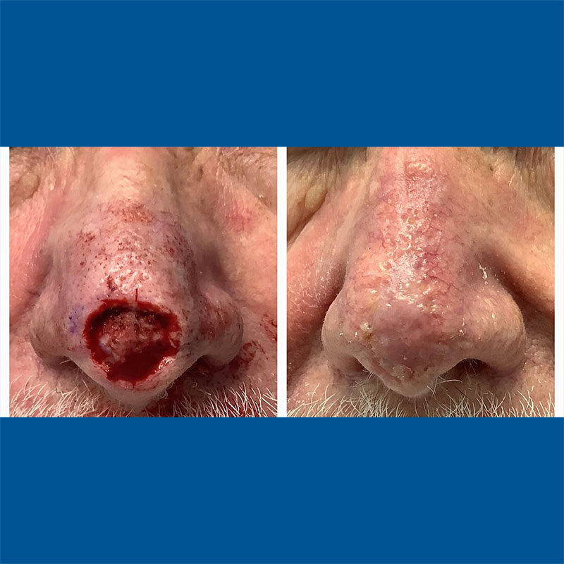 mohs-nose-surgery-before-and-after